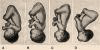 fetal presentation