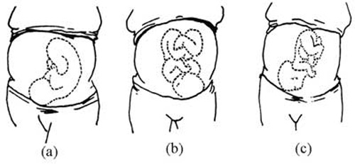 (a) baby facing the mother's back. (b) baby facing the mother's front. (c) baby with its chin up