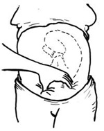 Pressing fingers firmly just above the pubic bone to feel the baby's head