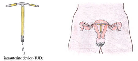 An intrauterine device