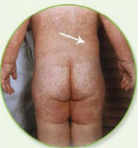 Measles rash covering the whole body of a child.
