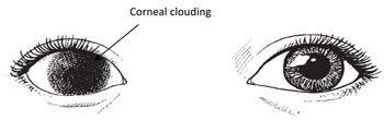 An eye with corneal clouding compared with a normal eye.