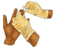 A patients finger being cleaned.