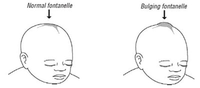 A normal fontanelle and a bulging fontanelle.