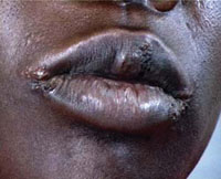 Small sores and cracks, at the corners of the mouth caused by angular chelitis.