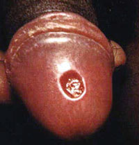 Primary syphilitic chancre.