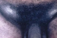 Raised solid bumps on both sides of the groin caused by granuloma inguinale.