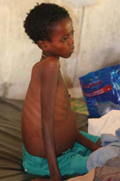 A child with visceral leishmanisis