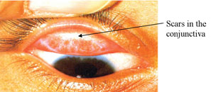 Scars in the conjunctiva