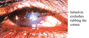 Turned in eyelashes rubbing the cornea