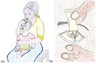Treating a child with tetracycline eye ointment