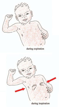Chest in-drawing during inspiration