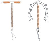 A copper-bearing IUCDs.