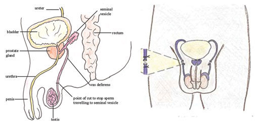 Male sterilisation.