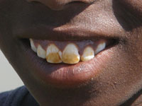 Fluorosis