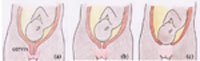 The three stages of effacement of the cervix.