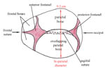 Moulding of the fetal skull may occur during descent; in this example, one parietal bone is overlapping the other at the sagittal suture. The occiput and the distance known as the bi-parietal diameter have been labelled.