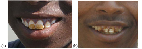 Dental fluorisis and tooth decay
