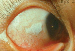 Bitot's spots on eye