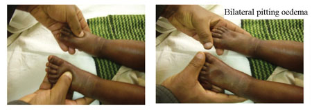 Checking for bilateral pitting oedema