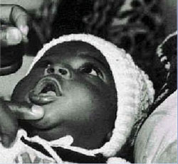Administering vitamin A capsule to an infant